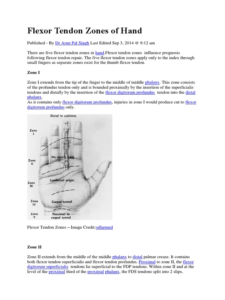 Flexor Tendon Zones of Hand PDF