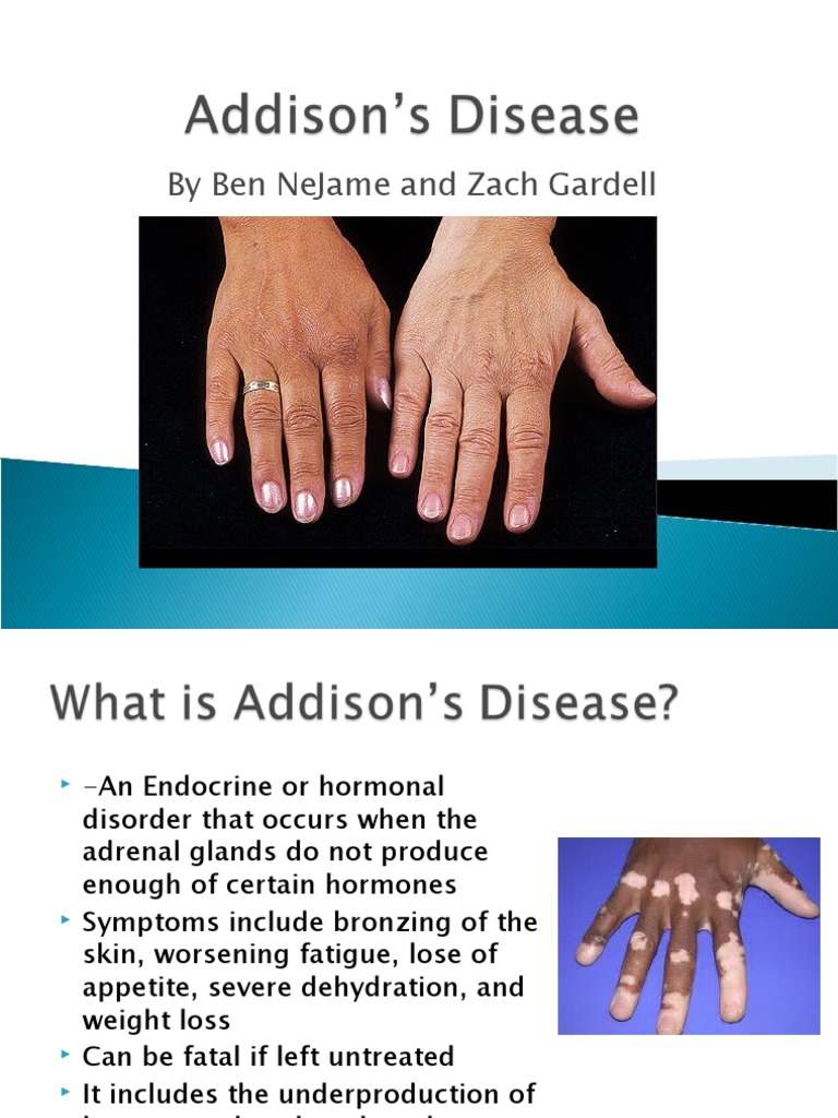 Addison's disease ppt for nursing students picture