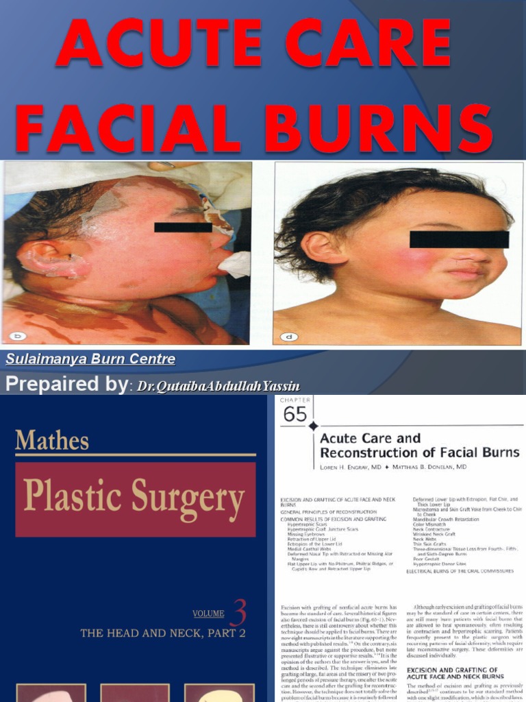 Management Of Facial Burns _ Burn Evaluation and Management – DTDOOI