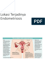 Lokasi Terjadinya Endometriosis dan Gejalanya