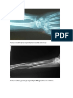 Fractura de cúbito.docx