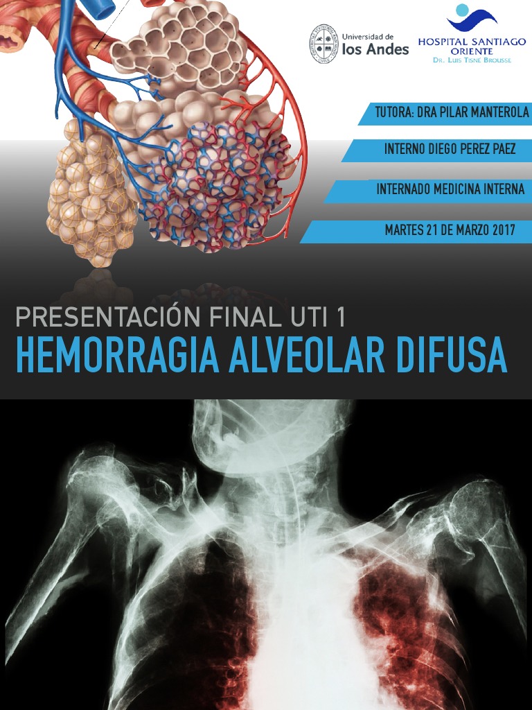 DIFFUSE ALVEOLAR HEMORRHAGE Neumonía Lupus eritematoso sistémico