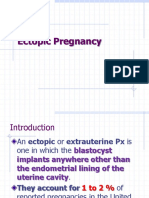 Ectopic Pregnancy.yibe