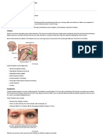 Cluster Headache - MedlinePlus Medical Encyclopedia