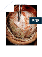 Meningitis y Encefálitis