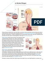 Cara Menyembuhkan Stroke Ringan