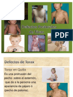 Defecto Postural de Torax