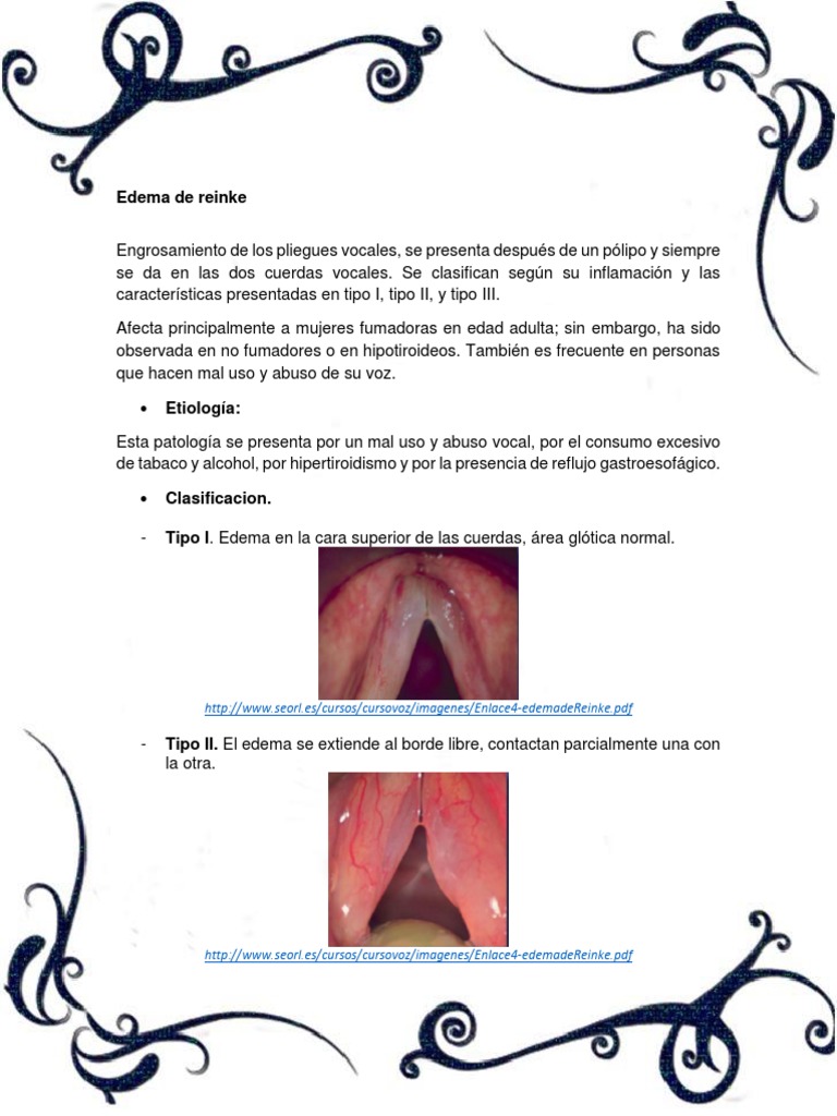Edema de Reinke causas, síntomas y tratamiento PDF Cirugía Nicotina