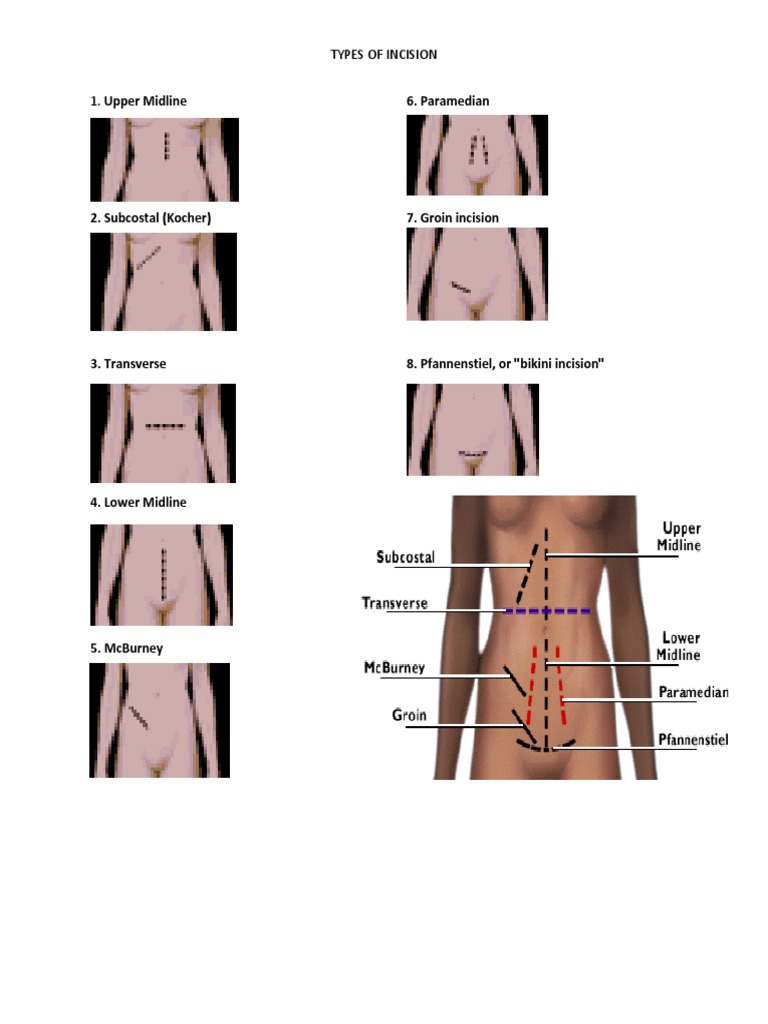 Types of Incision | PDF
