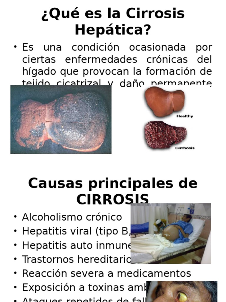 Diapositiva Cirrosis PDF