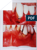 Resin Ionomer and Hybrid Ionomer Cements Wound Healing in Periodontal Lesions Dragoo 1997