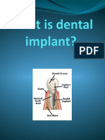 What Is Dental Implant