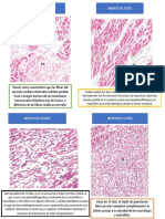 Histopatologia de Infarto Miocardio