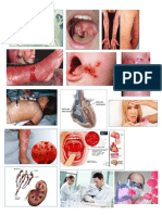 Streptococcus Pyogenes