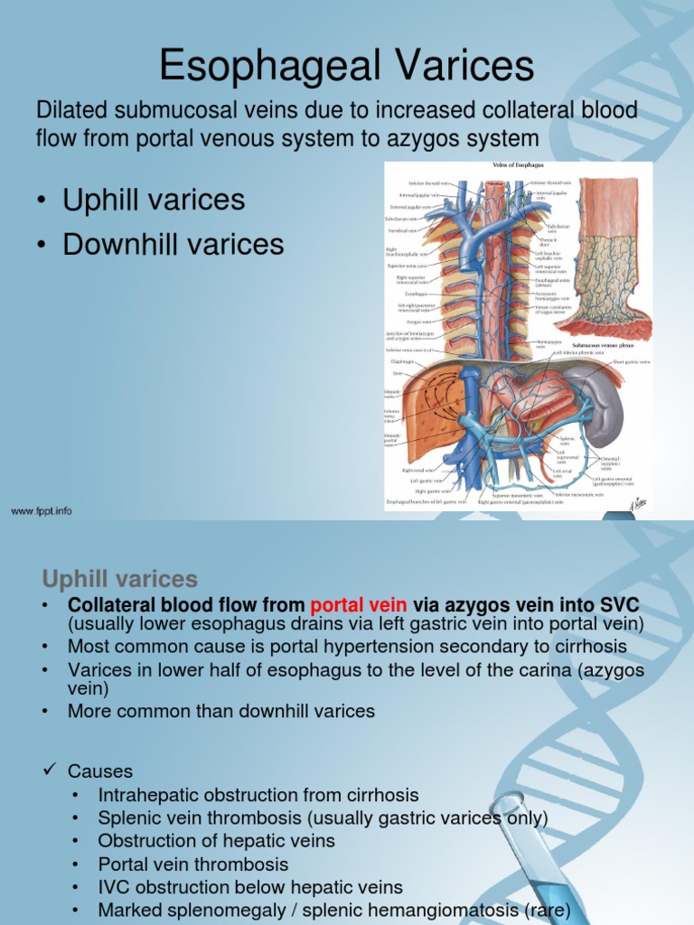 Esophageal Varices PDF