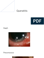 Queratitis