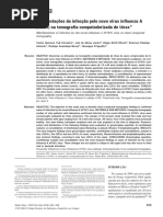 Manifestações Da Infecção Pelo Novo Vírus Influenza a (H1N1) Na Tomografia Computadorizada de Tórax