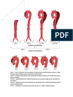 Aortic Dissection