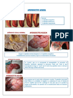 APENDICITIS AGUDA-Dr Pino