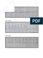 Ekg