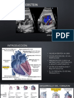 Anomalía de Ebstein en
