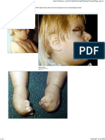 Aphert Syndrome PDF