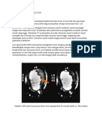 Mri Aneurysma Bone Cyst