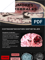 Tumores Cerebrales