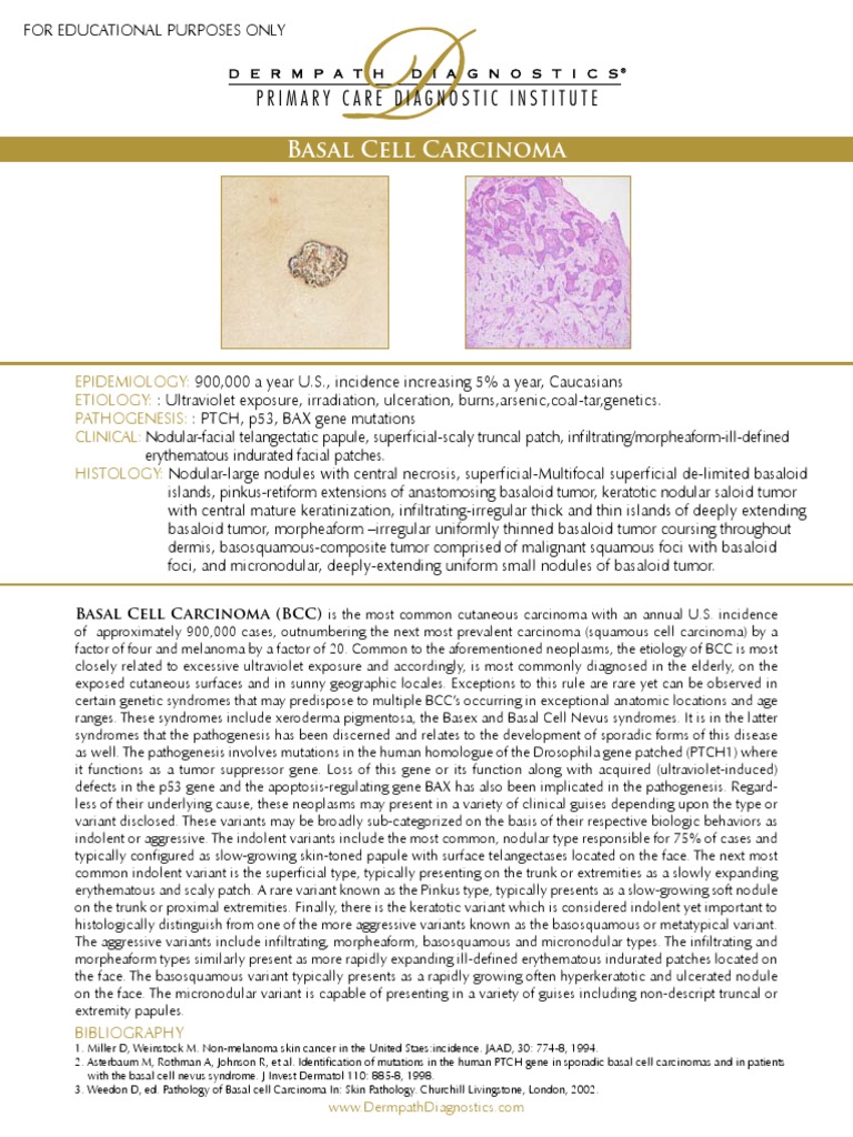Basal Cell Carcinoma | PDF | Neoplasms | Carcinoma