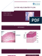 Histologia: Úlcera Gástrica Por Helicobacter Pylori