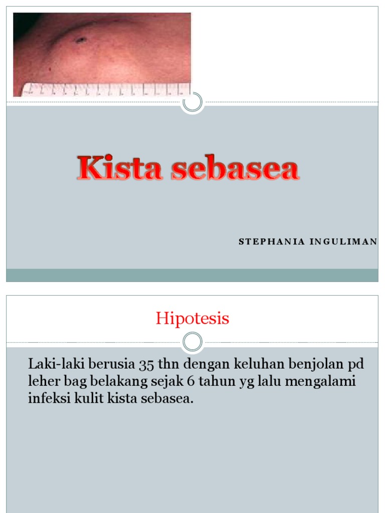 Kista Sebasea Adalah Benjolan Yg Terbentuk Pada Lapisan Kulit