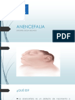 Anencefalia