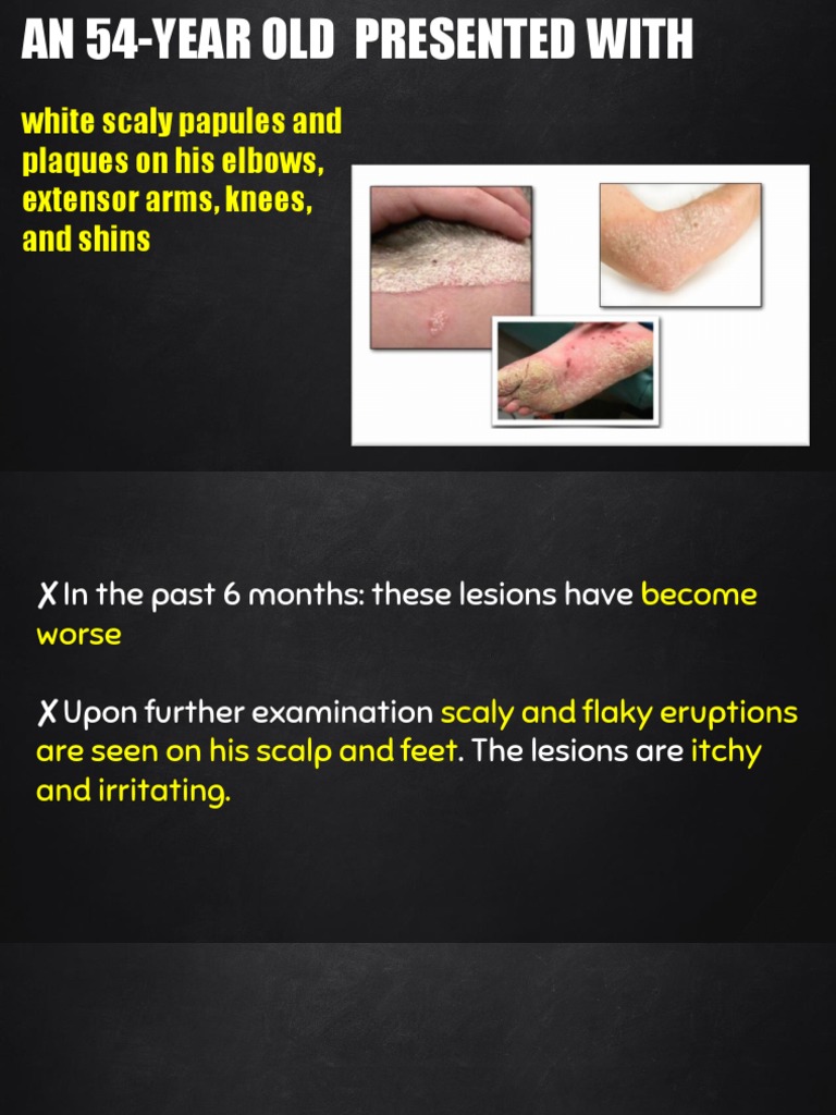 White Scaly Papules and Plaques On His Elbows, Extensor Arms, Knees ...