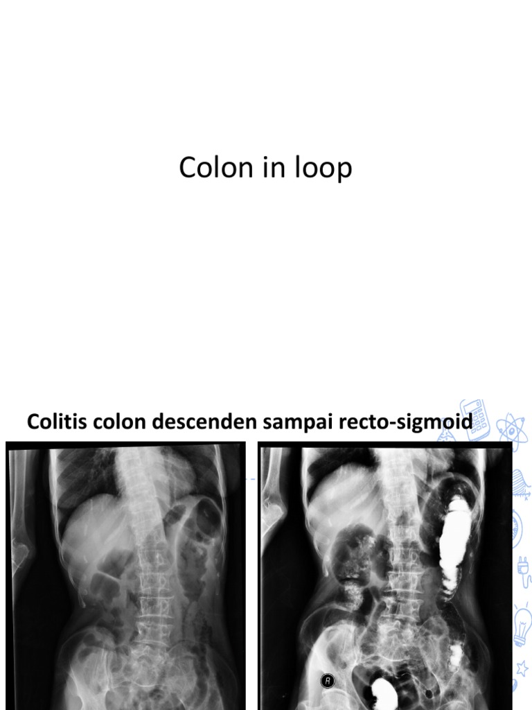 Teknik Radiologi Colon in Loop | PDF | Seni