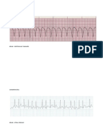 Gambaran Ekg