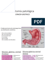 Anatomía Patológica Cancer de Estomago