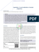 Intramyometrial Gestation: A Rare Localization of Ectopic Pregnancy