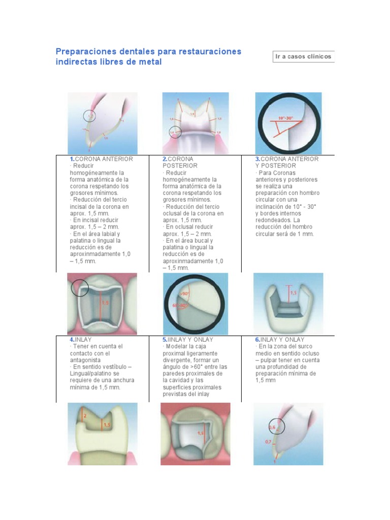 Preparación dentaria para coronas libres de metal