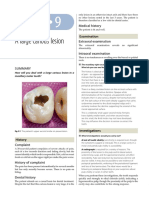 9-A Large Carious Lesion