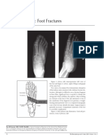 Foot Fractures