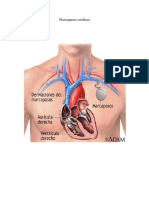 Marcapasos Cardíaco Imprimir