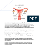 Endometriosis Gejala, Penyebab dan Pengobatan