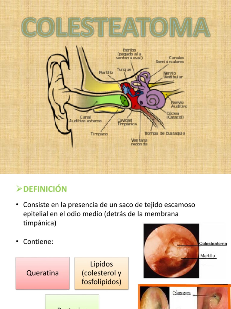 Colesteatoma: Definición y Tratamiento | PDF | Oído | Anatomía