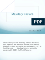 Mxillary Fracture