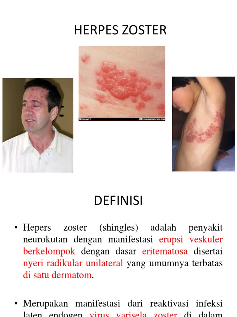 Herpes Zoster