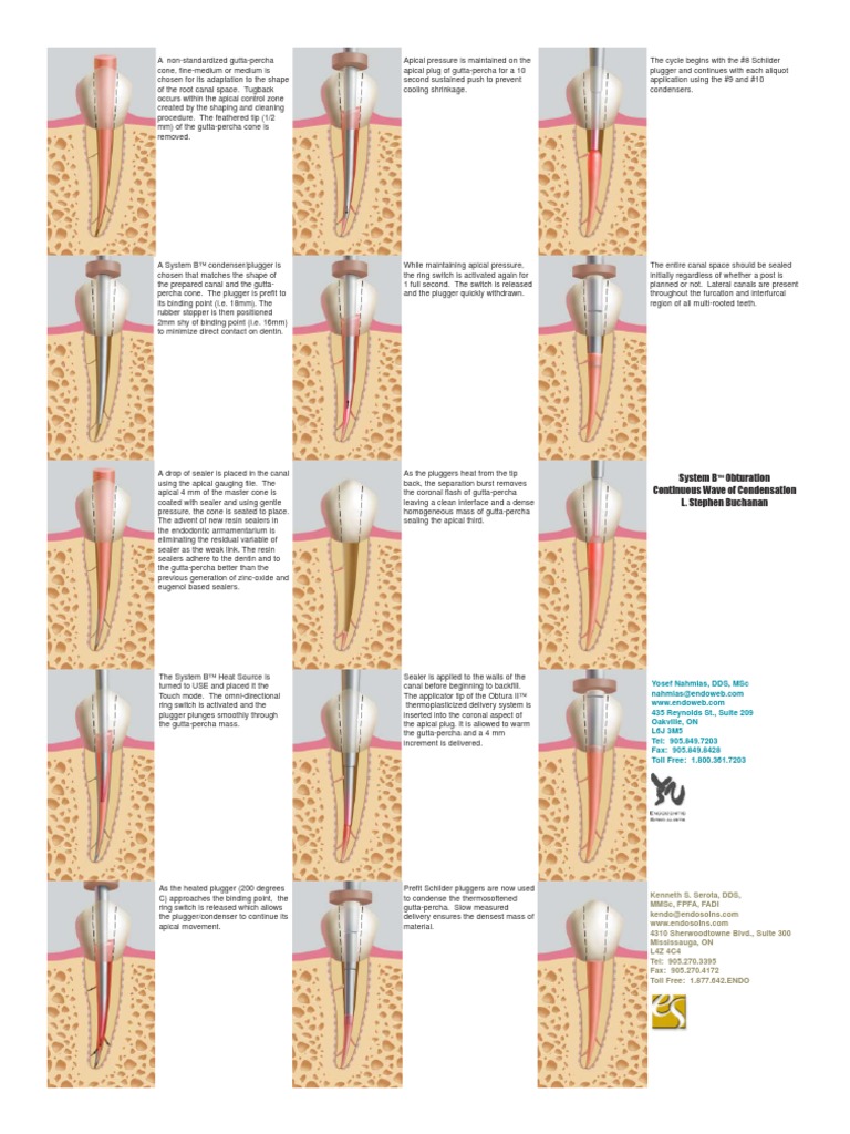 Endo System B Continous Wave Compaction Technique Nature