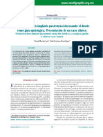 férulas quirúrgicas en implantología