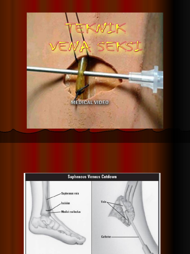 Semi-soft Vena main image 1