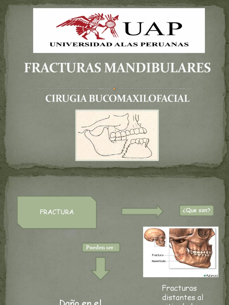 Fracturas Mandibulares | PDF | Hueso | Inflamación