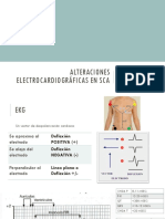 Alteraciones Electrocardiográficas en SCA